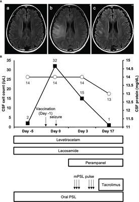 Single-cell RNA-seq analysis identifies distinct myeloid cells in a case with encephalitis temporally associated with COVID-19 vaccination